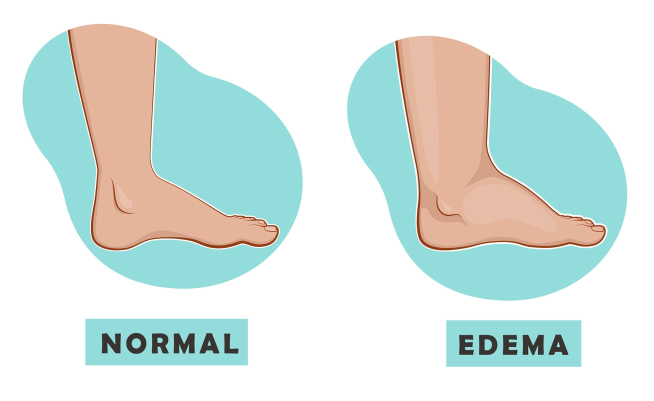 Why do you have only one swollen foot ?
