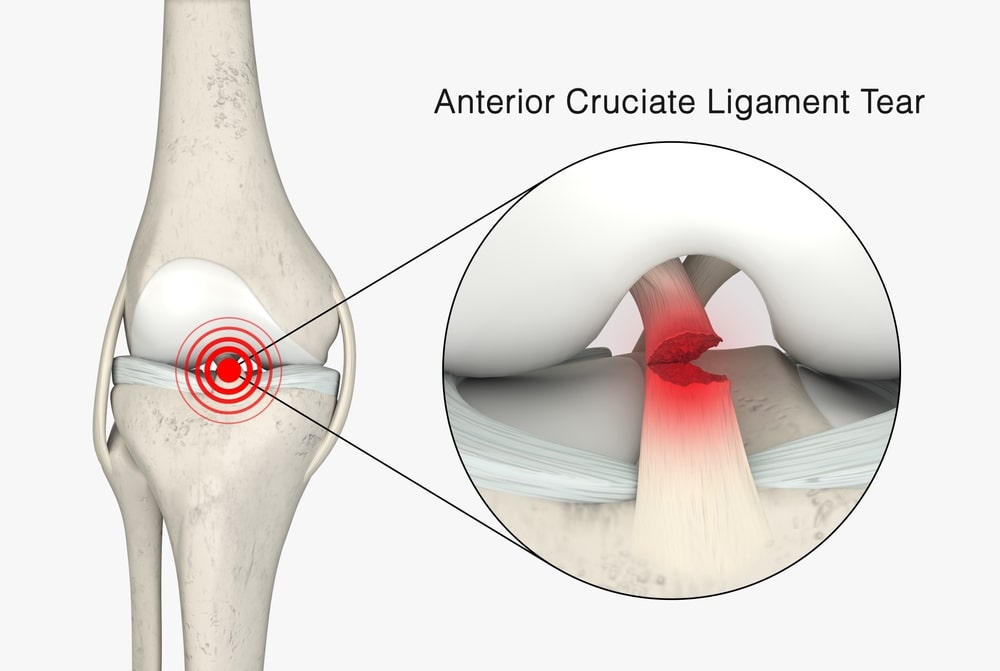 illustration of an ACL tear