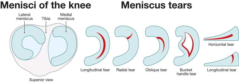 diagram of a meniscus tear