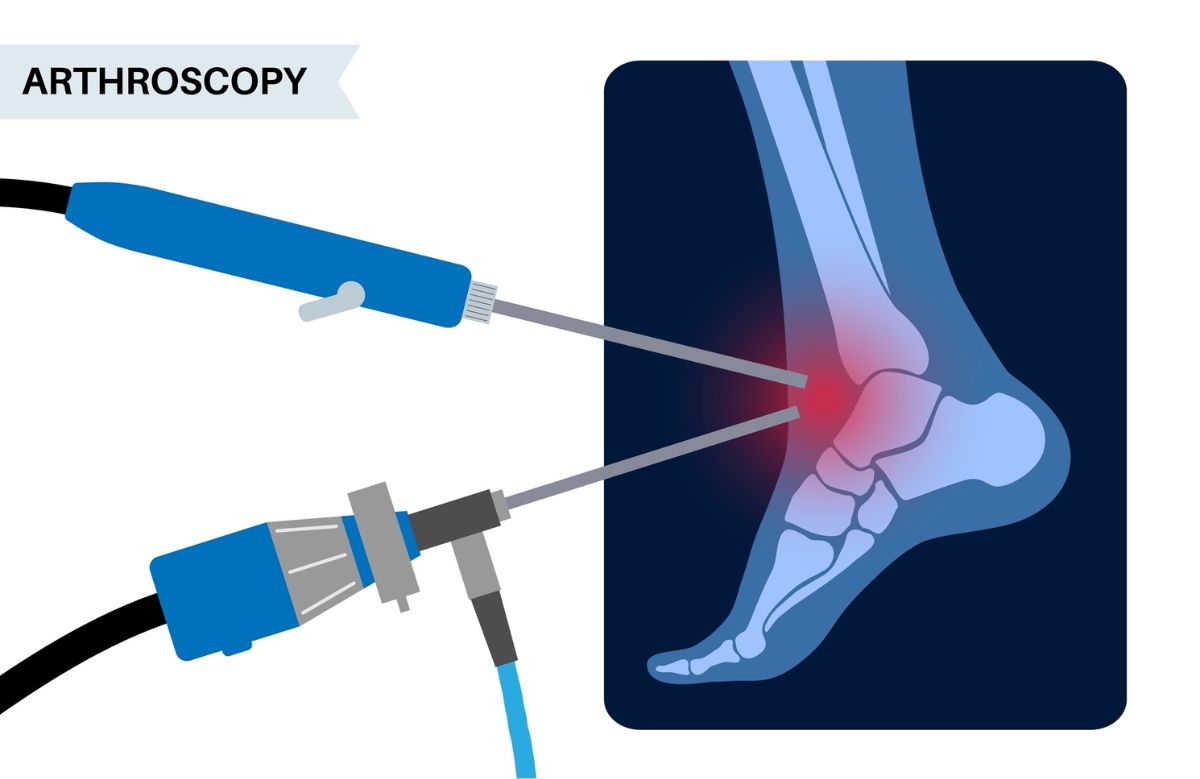 arthroscopy ankle surgery diagram