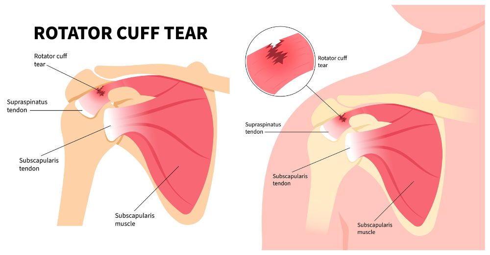 diagram of a rotator cuff tear