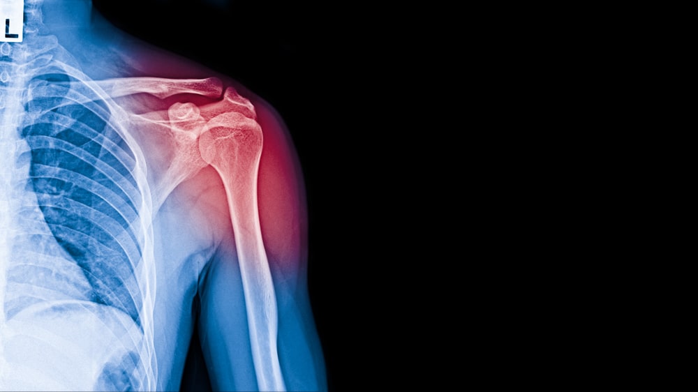 x-ray of shoulder pain